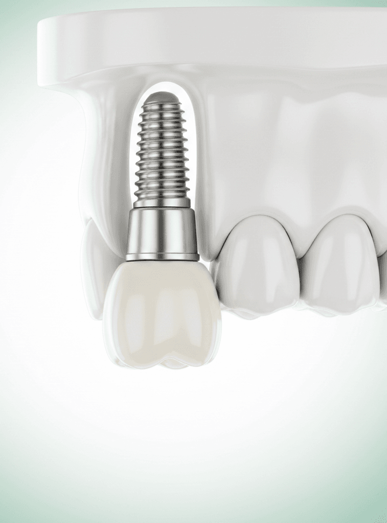 Dental Implants